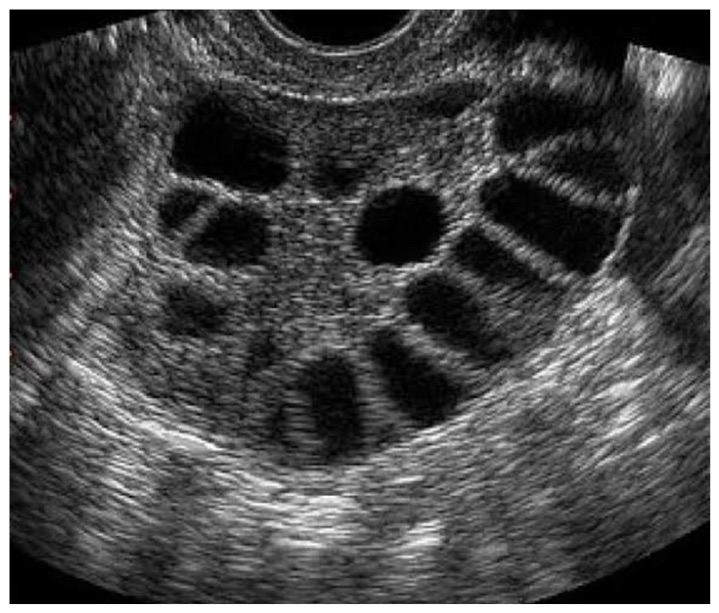 多嚢胞性卵巣症候群（PCOS）と診断されたときに読む話 – にしじまクリニックブログ
